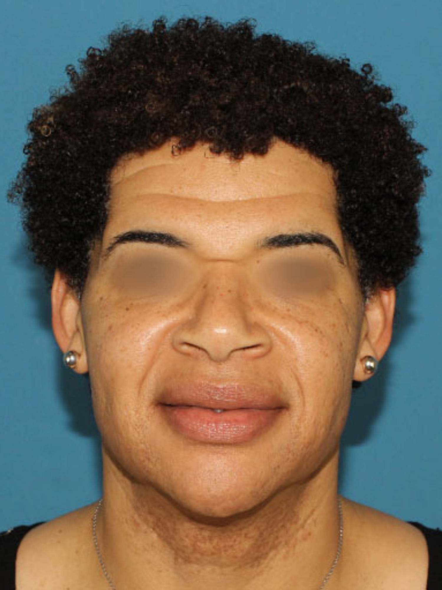 Facial Feminization Surgery Before & After Image