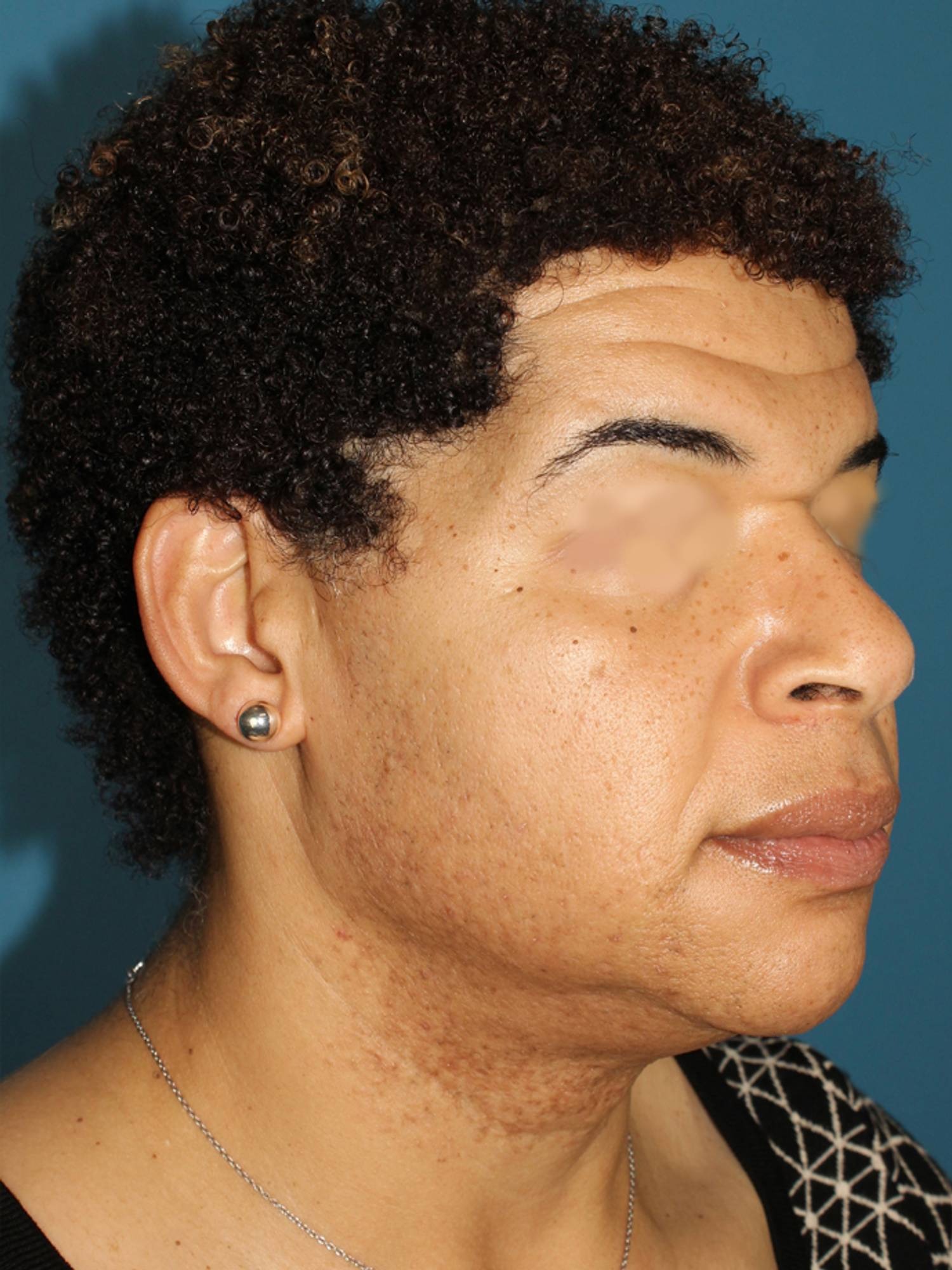 Facial Feminization Surgery Before & After Image