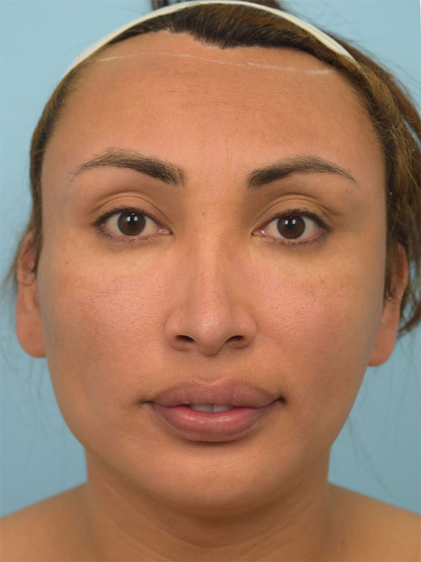 Facial Feminization Surgery Before & After Image