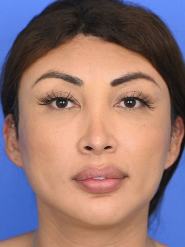 Facial Feminization Surgery Before & After Image