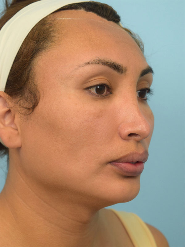 Facial Feminization Surgery Before & After Image