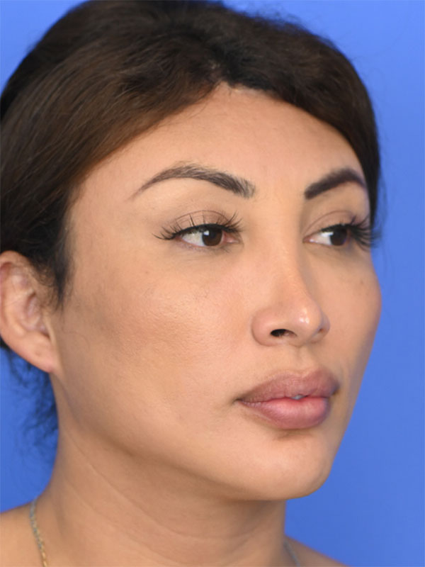 Facial Feminization Surgery Before & After Image