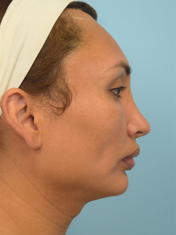 Facial Feminization Surgery Before & After Image