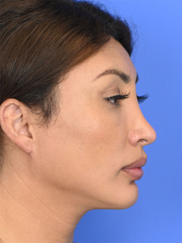 Facial Feminization Surgery Before & After Image