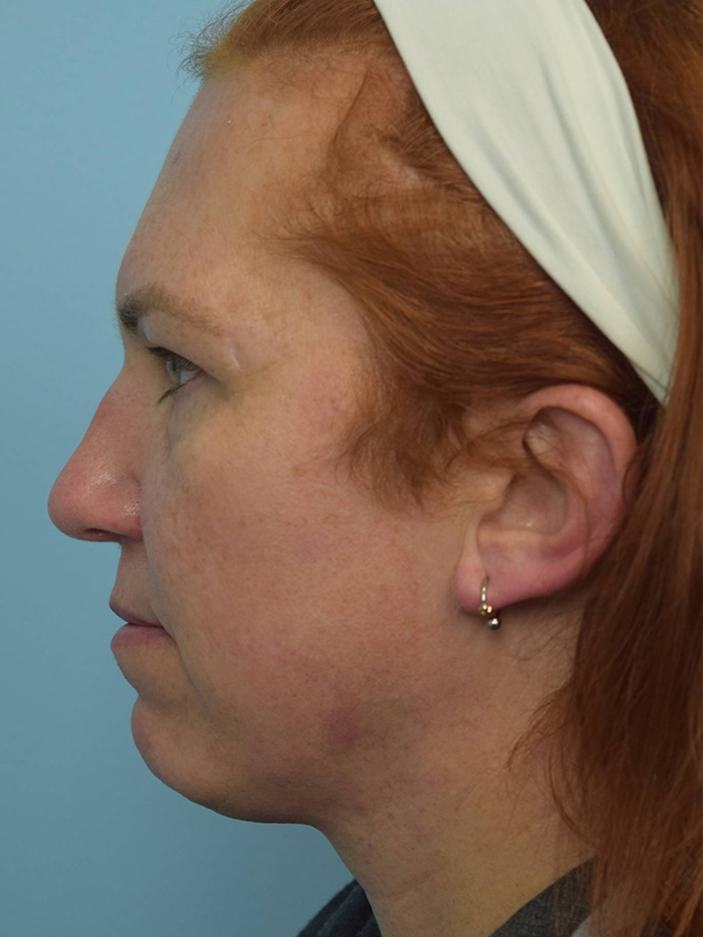 Facial Feminization Surgery Before & After Image