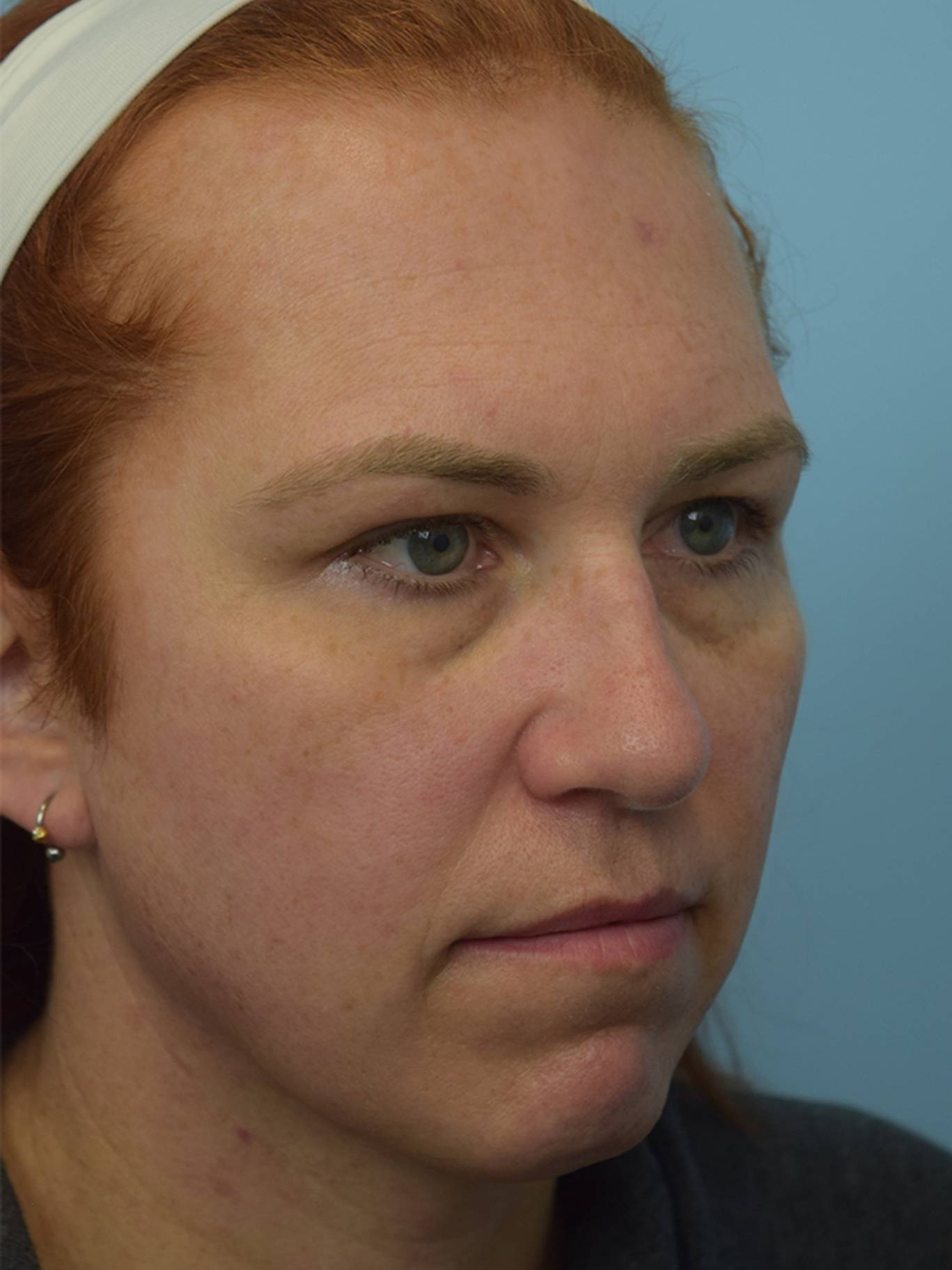 Facial Feminization Surgery Before & After Image