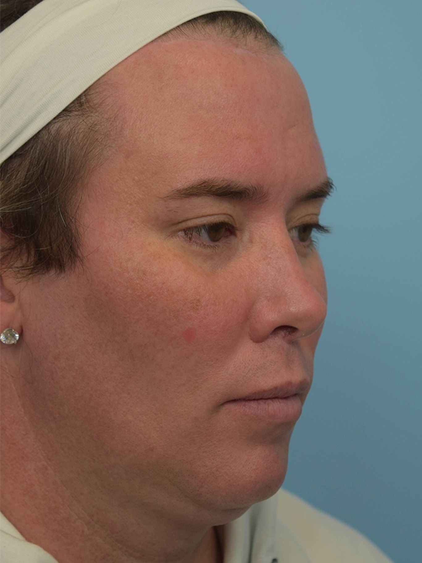 Facial Feminization Surgery Before & After Image