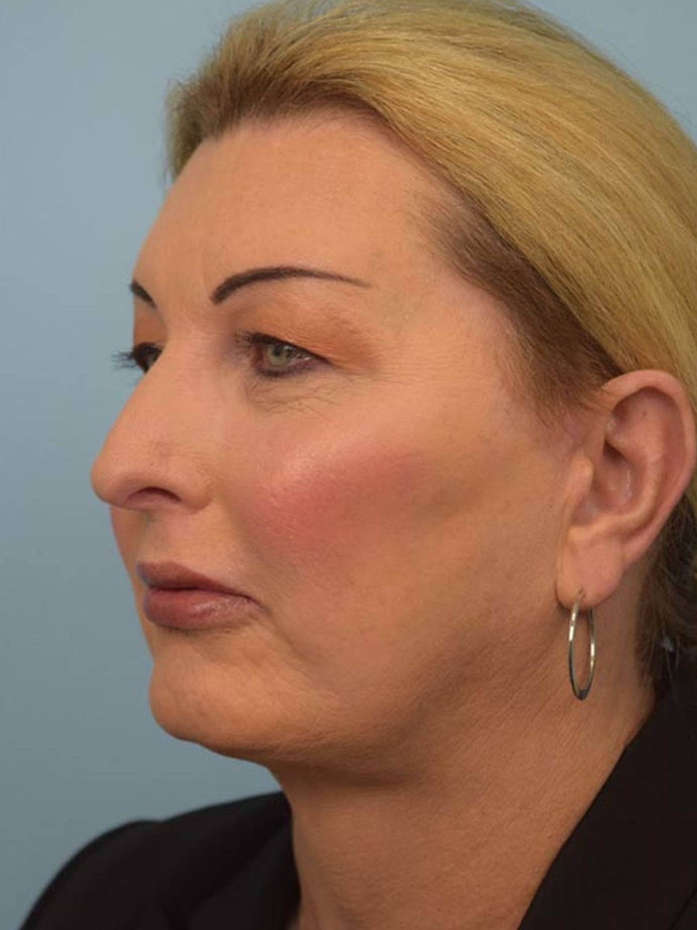 Facial Feminization Surgery Before & After Image