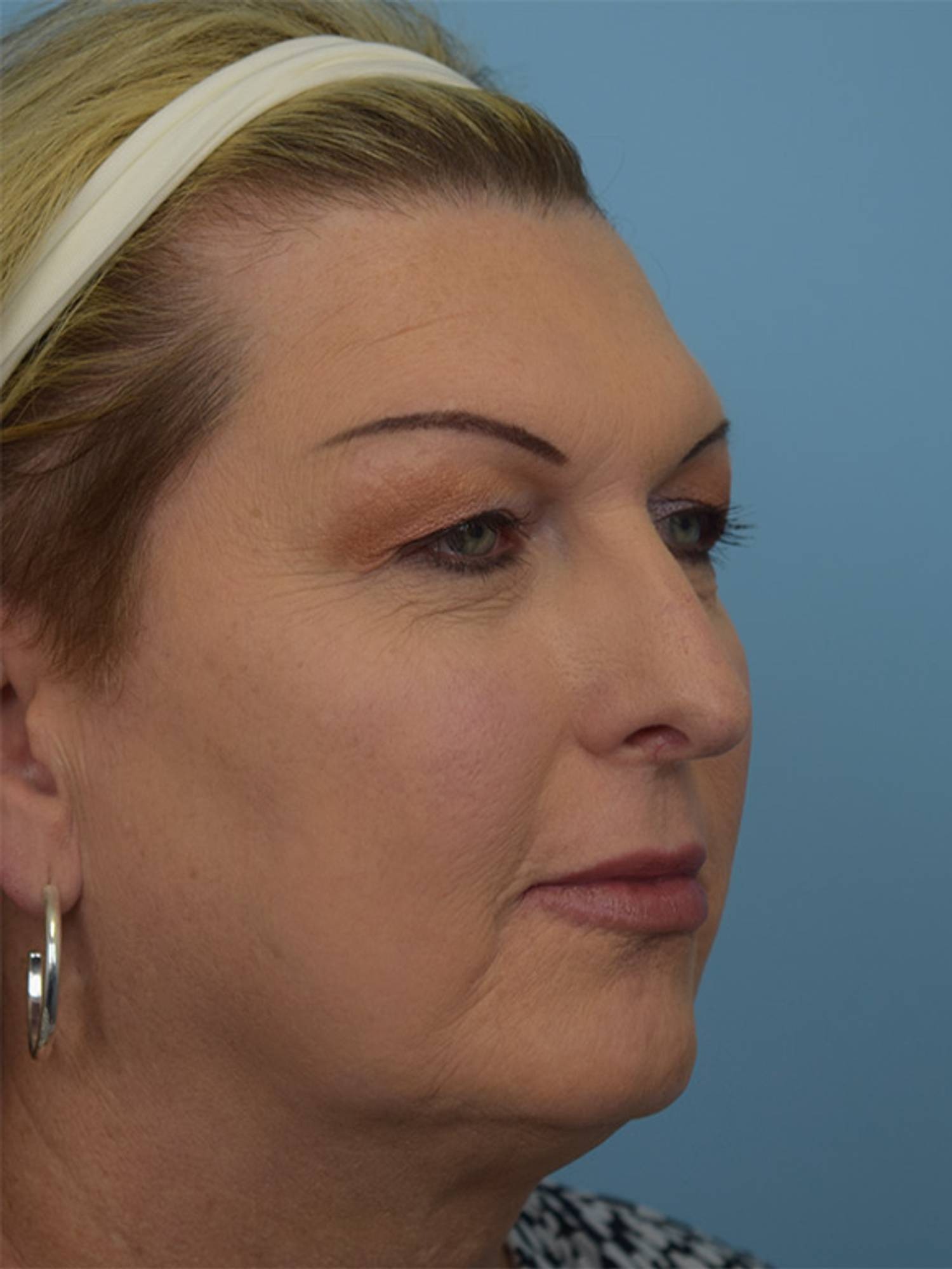 Facial Feminization Surgery Before & After Image