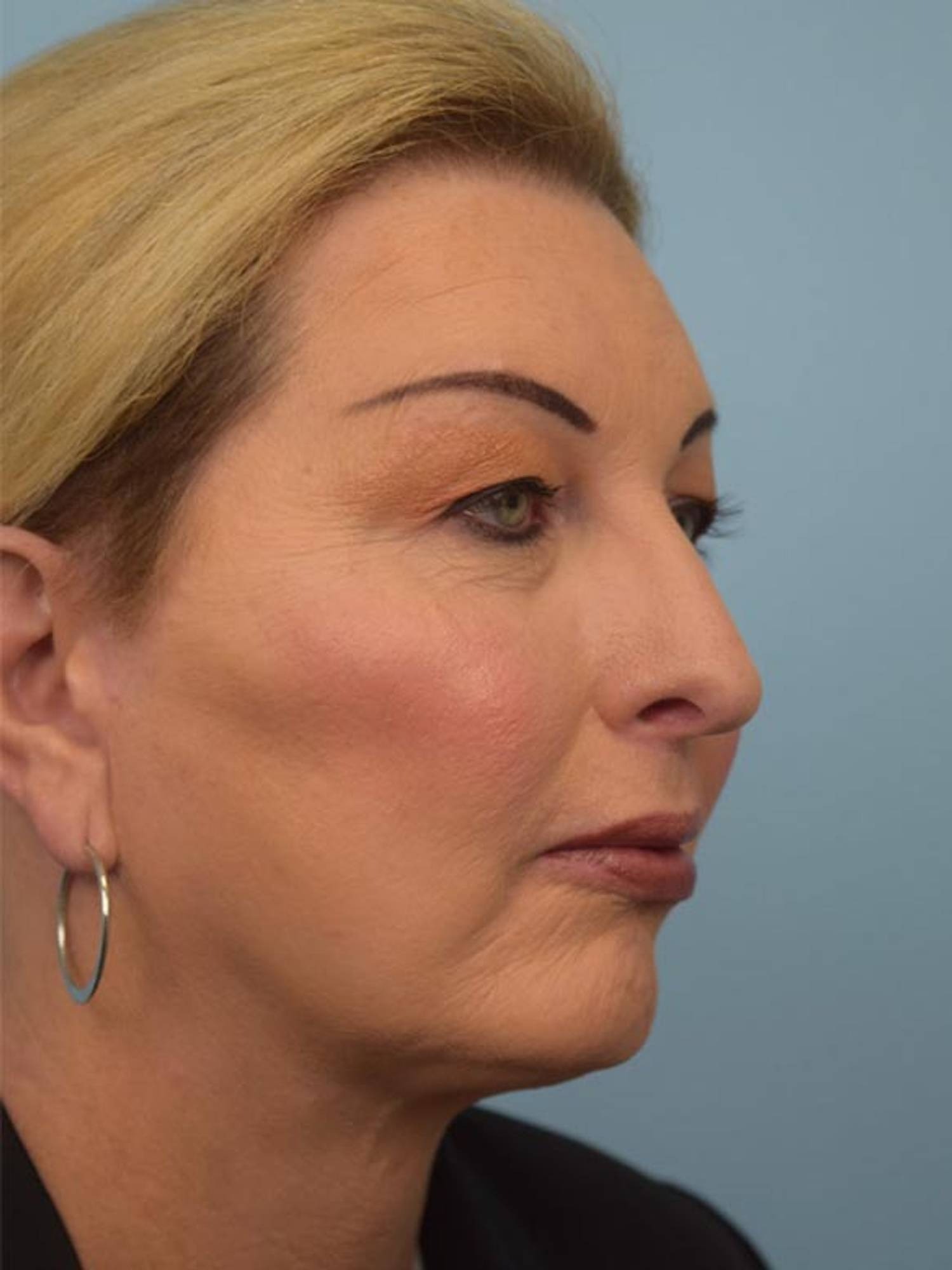 Facial Feminization Surgery Before & After Image