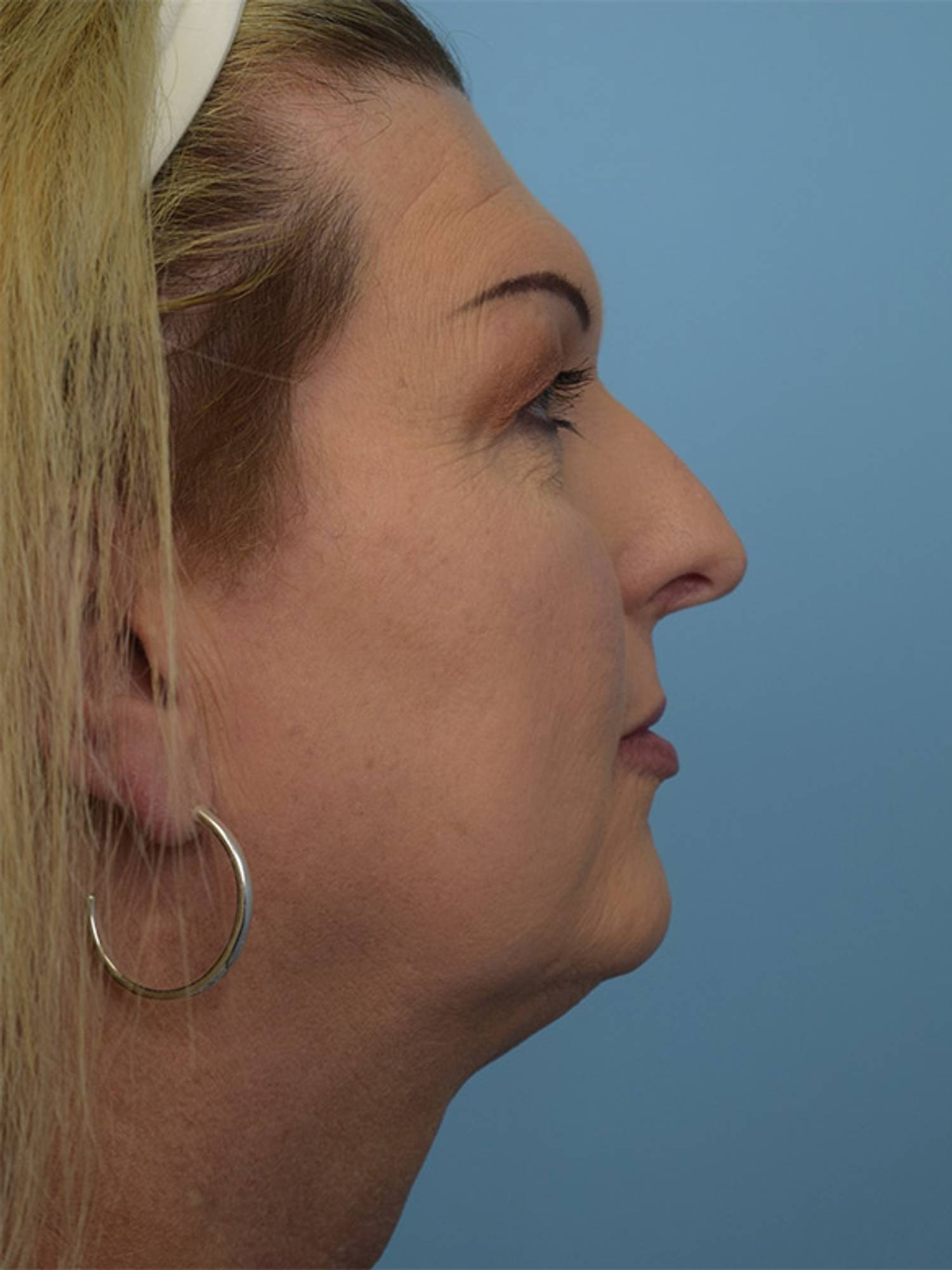 Facial Feminization Surgery Before & After Image