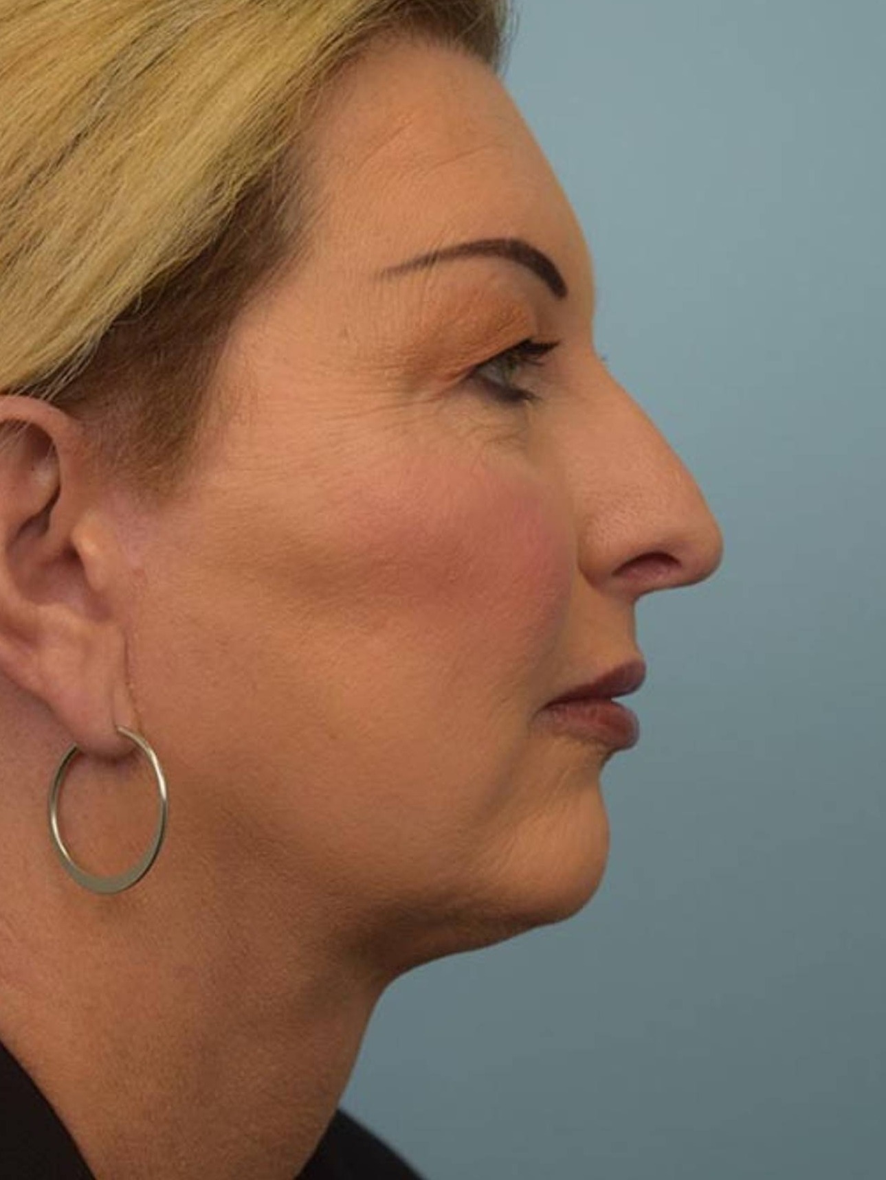 Facial Feminization Surgery Before & After Image