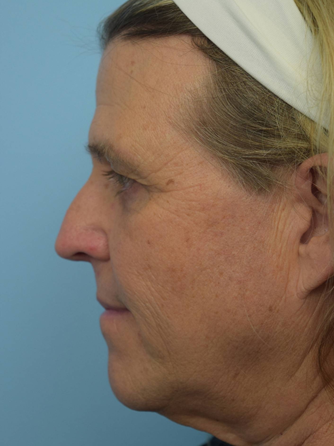 Facial Feminization Surgery Before & After Image