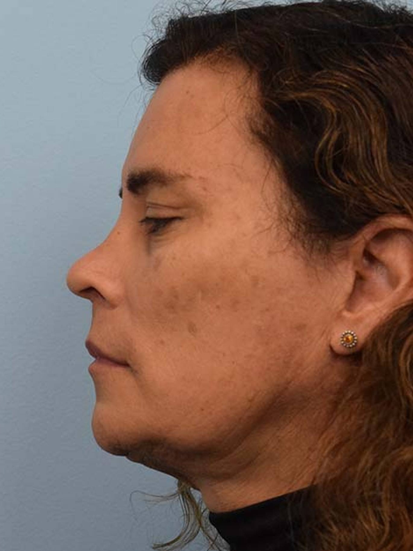 Facial Feminization Surgery Before & After Image