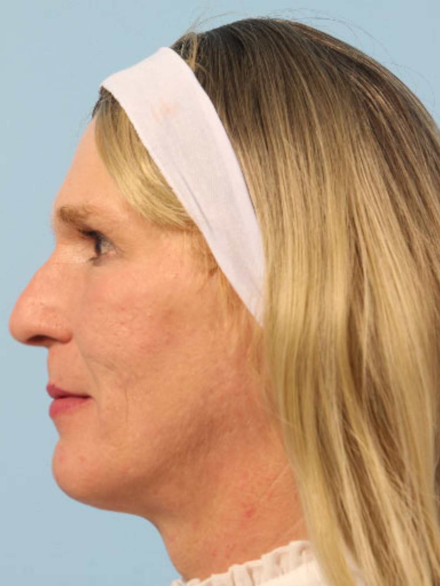 Facial Feminization Surgery Before & After Image