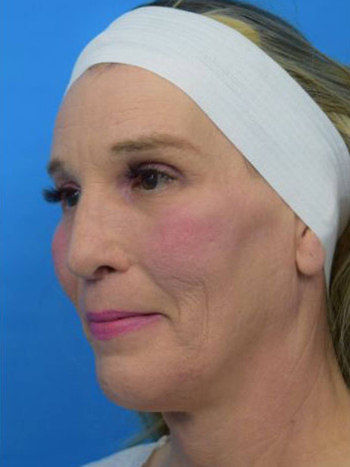 Facial Feminization Surgery Before & After Image