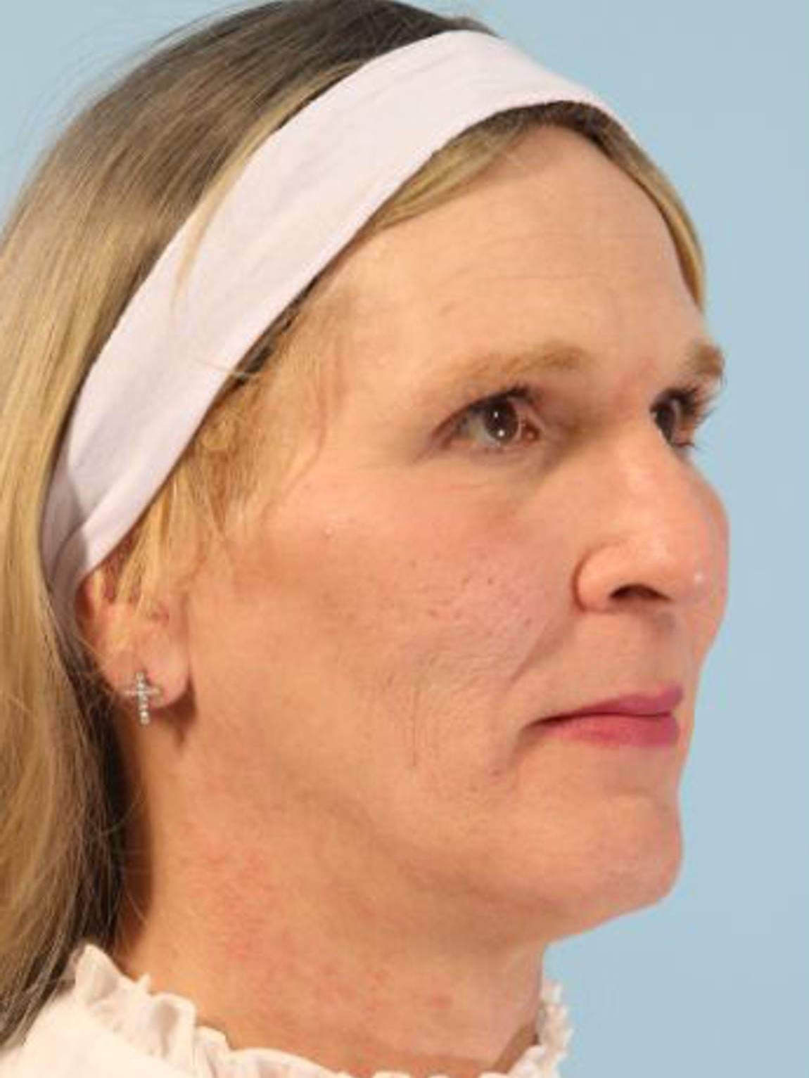 Facial Feminization Surgery Before & After Image