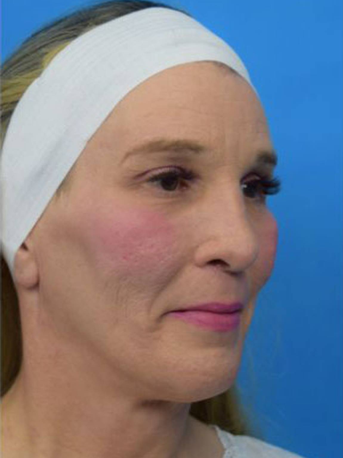 Facial Feminization Surgery Before & After Image