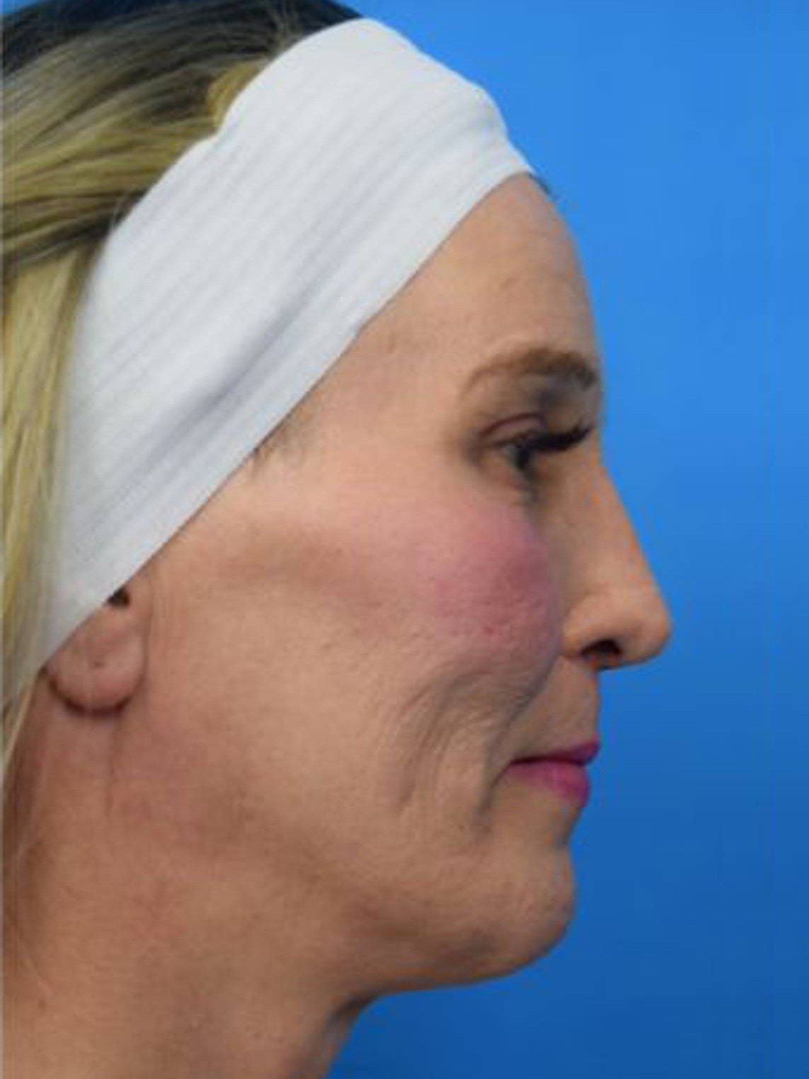 Facial Feminization Surgery Before & After Image