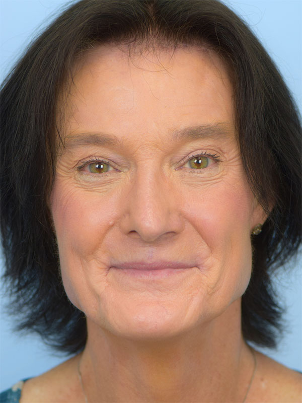 Facial Feminization Surgery Before & After Image