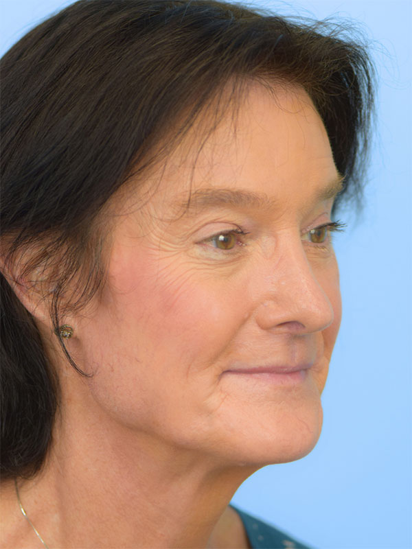 Facial Feminization Surgery Before & After Image