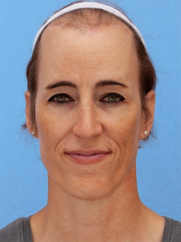 Facial Feminization Surgery Before & After Image