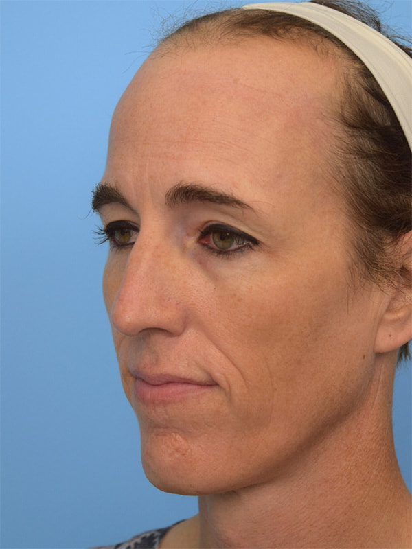 Facial Feminization Surgery Before & After Image