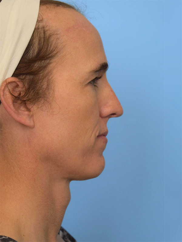 Facial Feminization Surgery Before & After Image