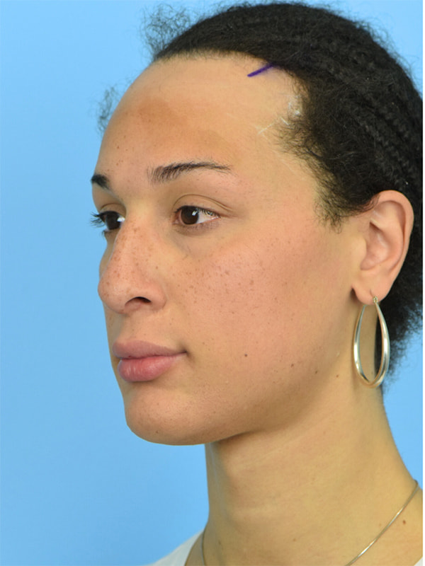 Facial Feminization Surgery Before & After Image