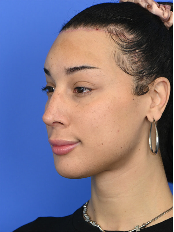 Facial Feminization Surgery Before & After Image