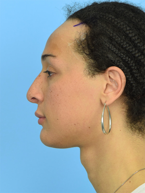 Facial Feminization Surgery Before & After Image