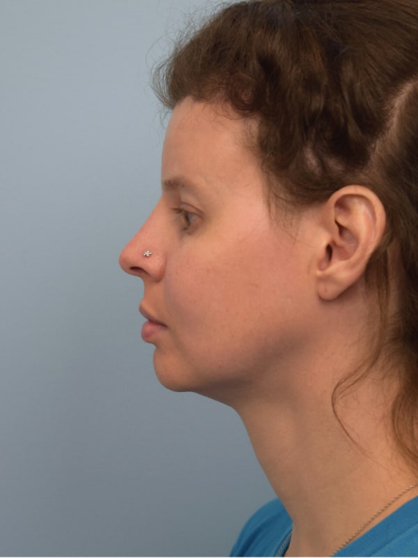 Facial Feminization Surgery Before & After Image