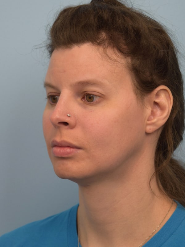 Facial Feminization Surgery Before & After Image