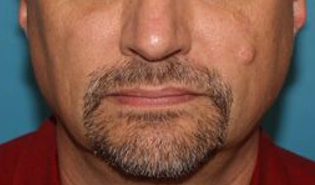 Facial Mass Removal Before & After Image