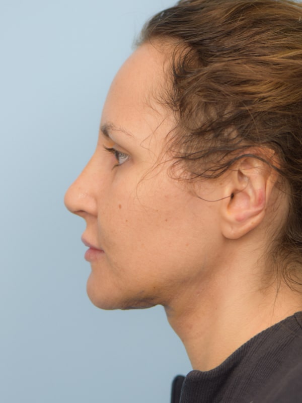 Profileplasty Before & After Image