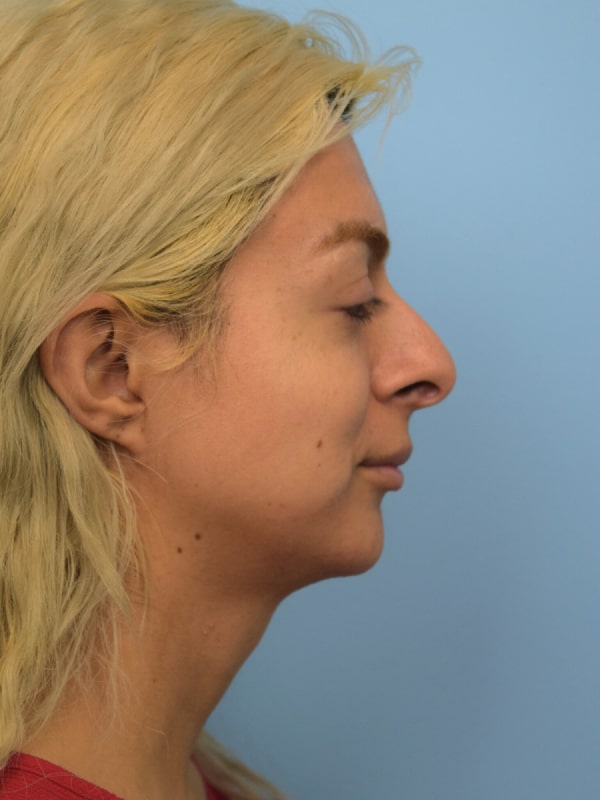 Profileplasty Before & After Image