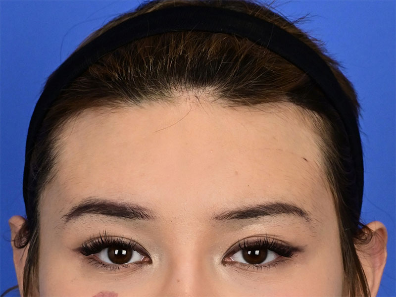 Brow Bossing Reduction Before & After Image