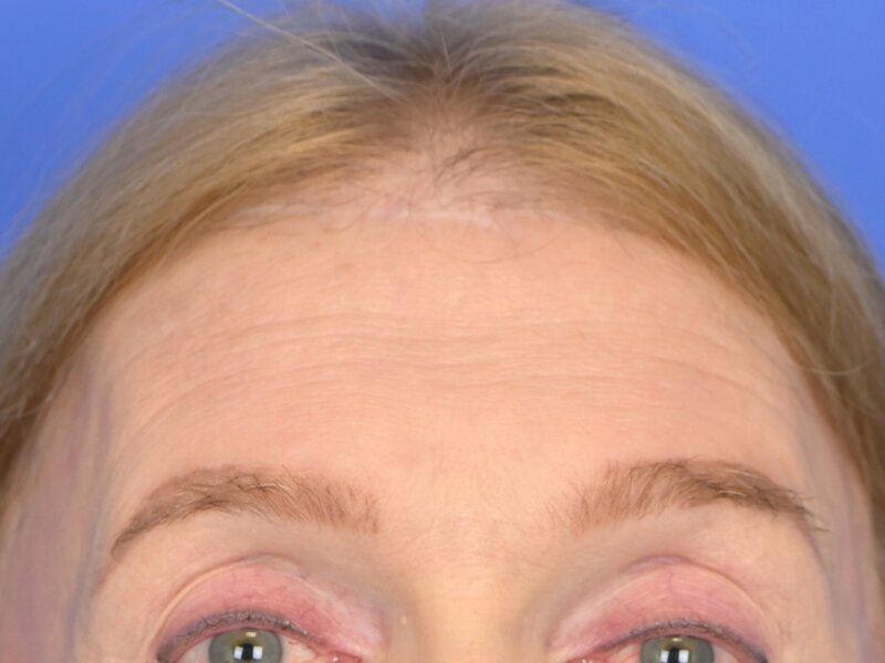 Brow Bossing Reduction Before & After Image