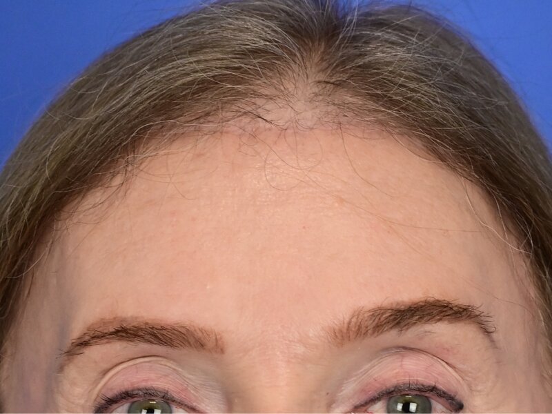 Brow Bossing Reduction Before & After Image