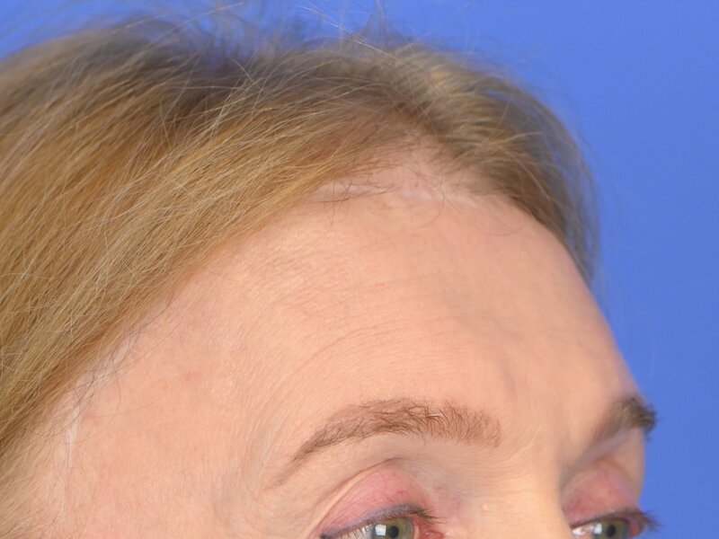 Brow Bossing Reduction Before & After Image