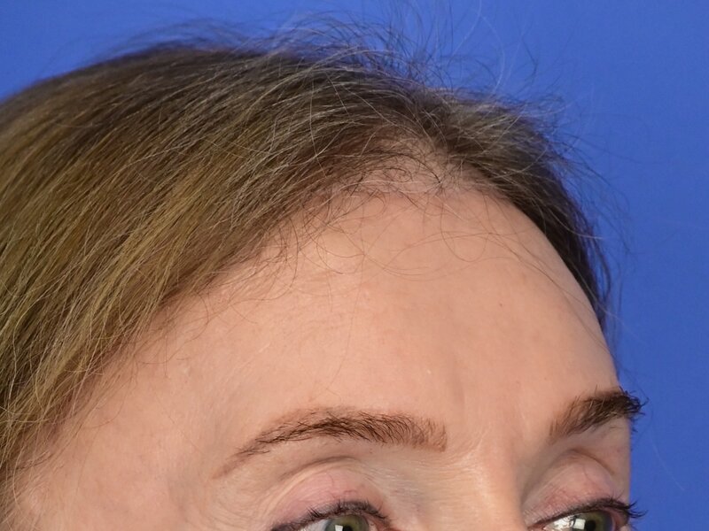 Brow Bossing Reduction Before & After Image