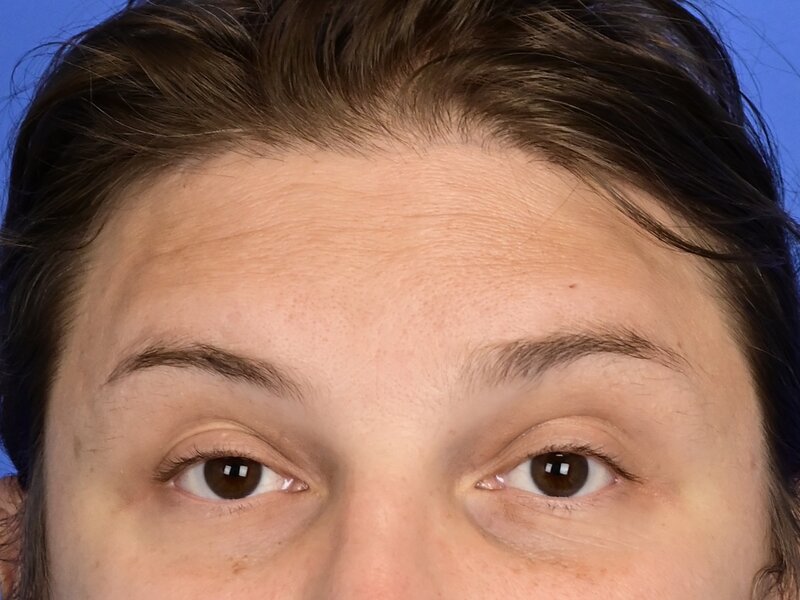 Brow Bossing Reduction Before & After Image