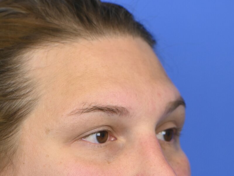 Brow Bossing Reduction Before & After Image