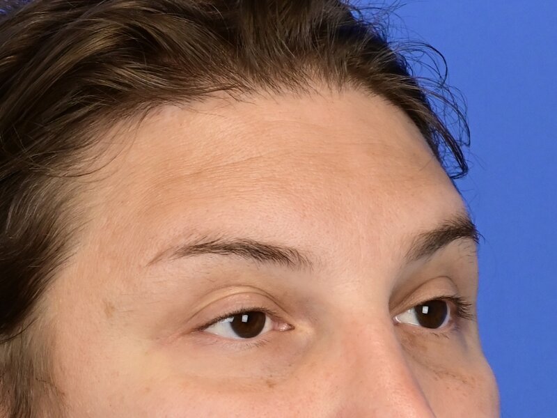 Brow Bossing Reduction Before & After Image