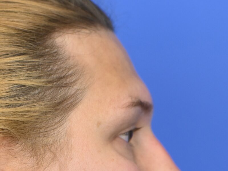 Brow Bossing Reduction Before & After Image