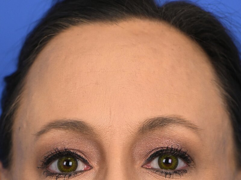 Brow Lift Before & After Image