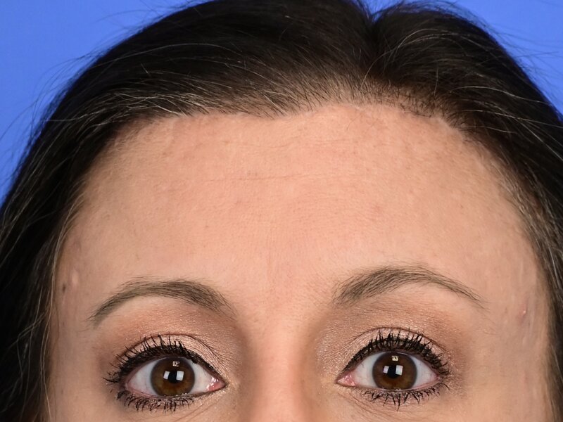 Brow Lift Before & After Image