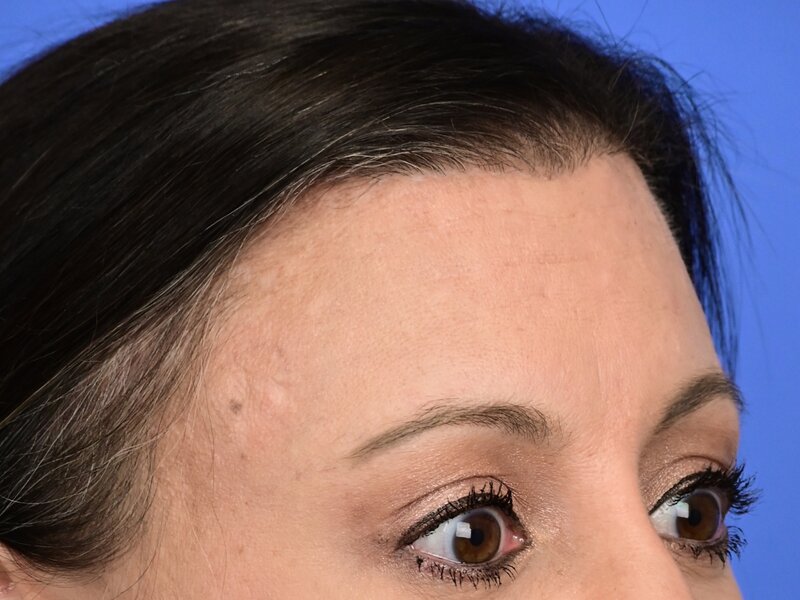 Brow Lift Before & After Image