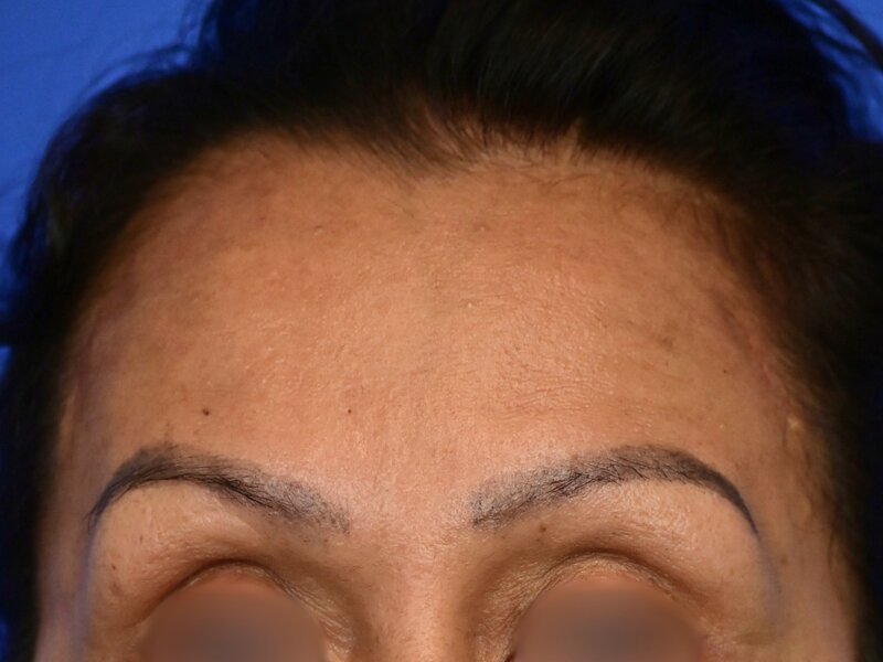 Brow Lift Before & After Image