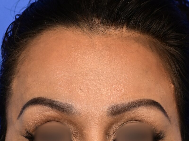 Brow Lift Before & After Image